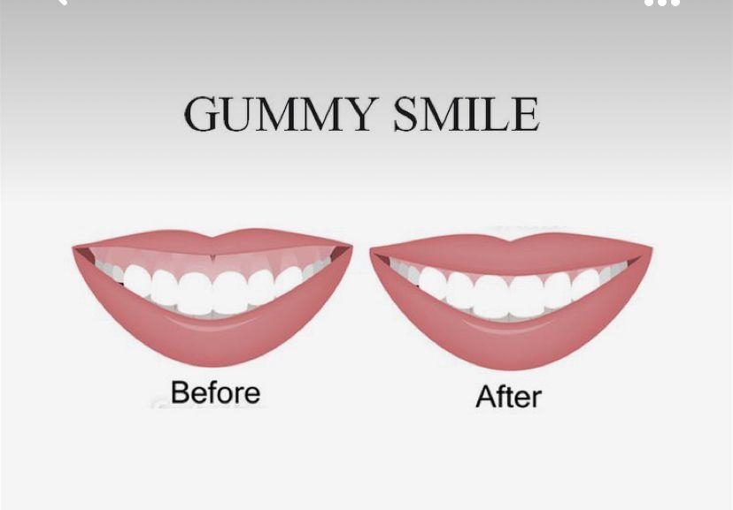 Gummy Smile: откройте свою улыбку заново